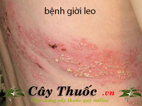 bệnh giời leo