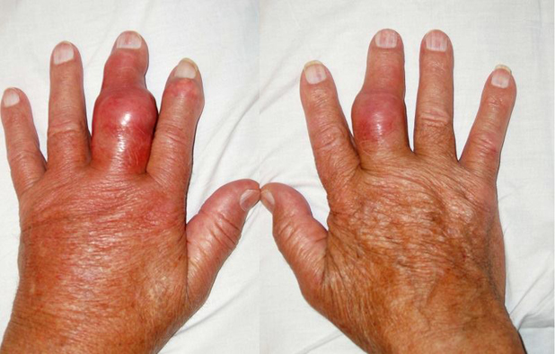 điều trị bệnh gout bằng cây tơm trơng