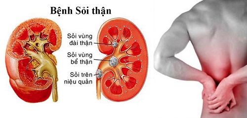 cây cối xay chữa sỏi thận