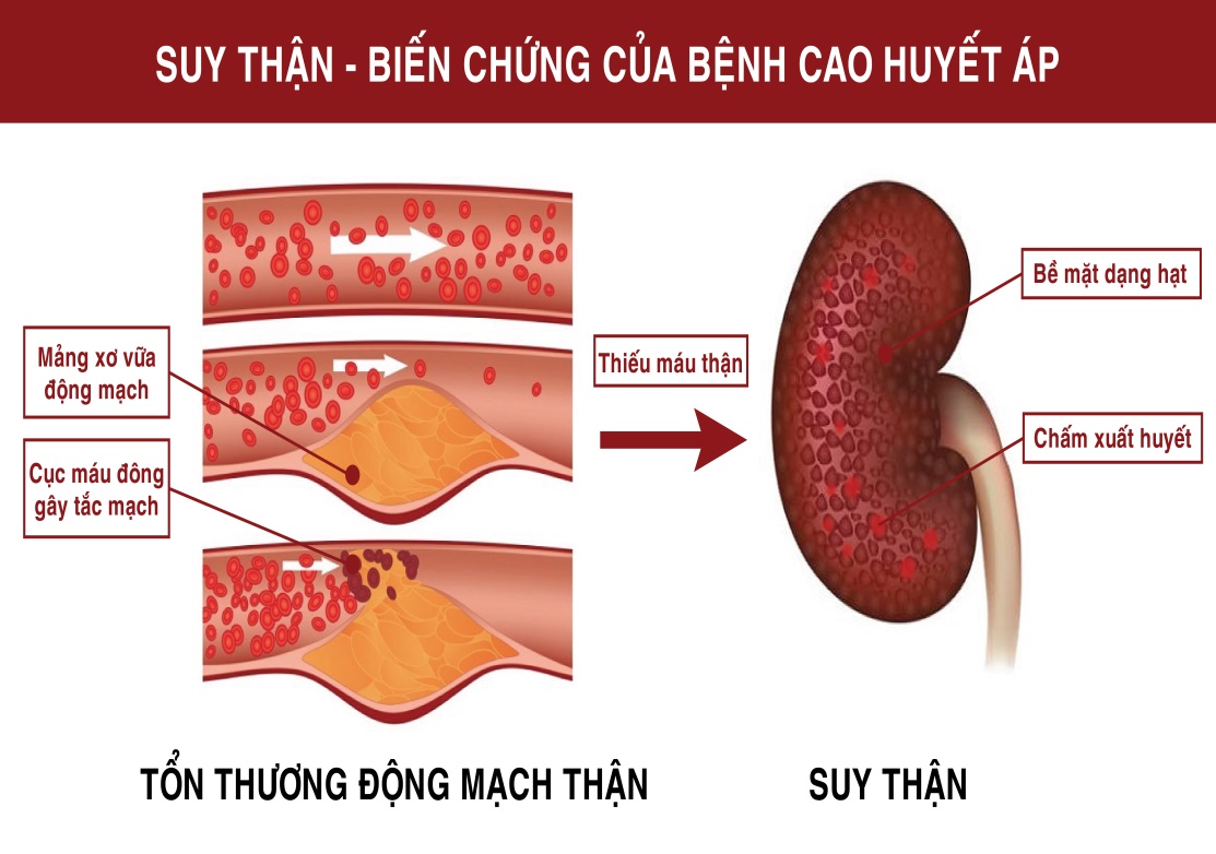 bệnh suy thận