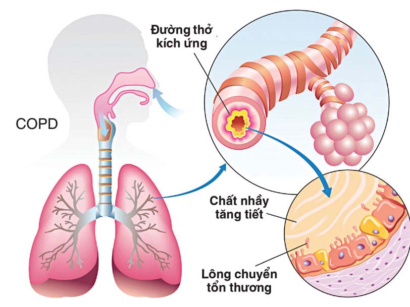 bệnh phổi tắc nghẽn mạn tính