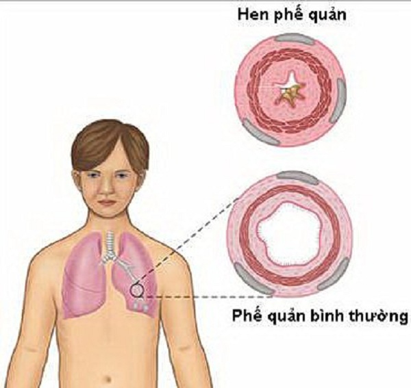 công dụng của bạch giới tử chữa hen suyễn