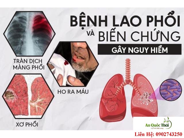 dấu hiệu bệnh lao