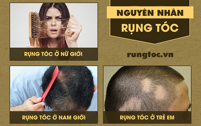 cây thông đất trị gàu và rụng tóc