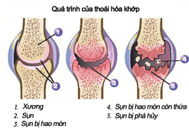 quá trình thoái hóa khớp