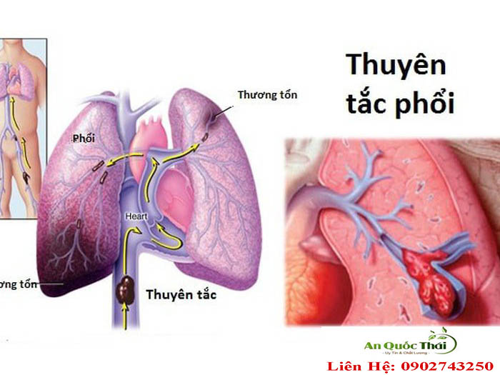 thuyên tắc phổi