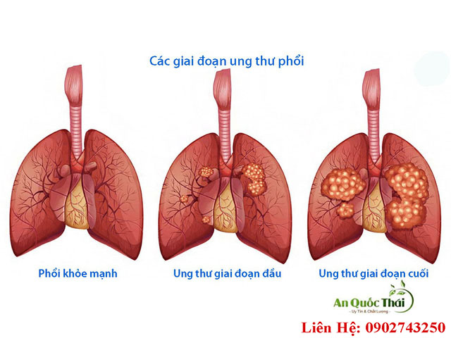 ung thư phổi