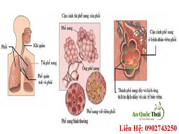viêm màn phổi