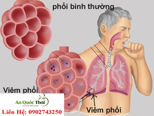 viêm phổi