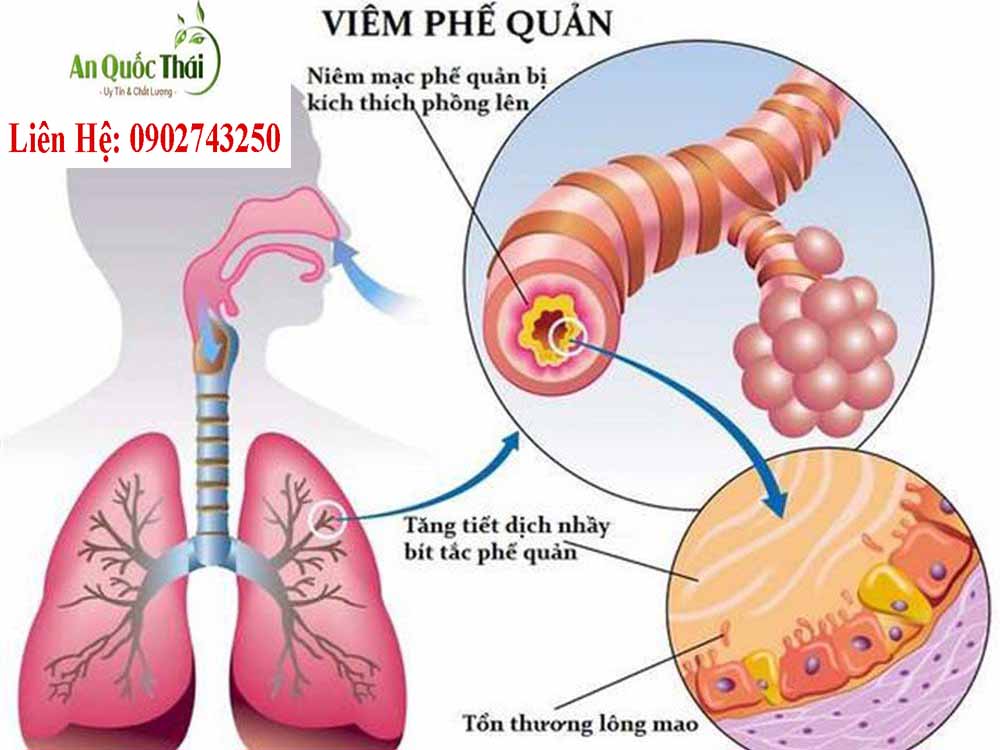 bệnh viêm phế quản