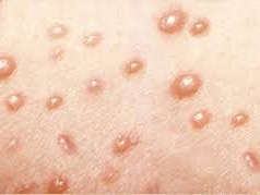 Lá tắm chữa khỏi hoàn toàn: Bệnh thủy đậu (trái rạ), bệnh đậu mùa và  giời leo, zola thần kinh.