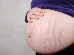 Bị rạn da màu đỏ phải làm sao? Cách chữa rạn da tại nhà hiệu quả