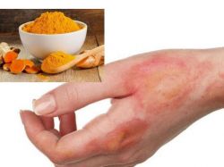 7 cách trị sẹo bỏng thâm hiệu quả chuẩn y khoa 7 cách trị sẹo bỏng thâm hiệu quả chuẩn y khoa