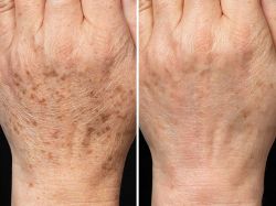 Tự nhiên tay nổi đốm nâu có sao không? Cách chữa trị