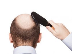 Rụng tóc ở nam tuổi 20 có sao không? Cách khắc phục hiệu quả